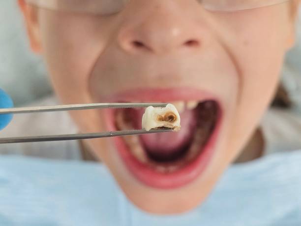 Best Urgent Care for Lost Fillings or Crowns in Lock Haven, PA